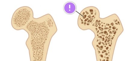 hyperparathyroidism can cause osteoporosis
